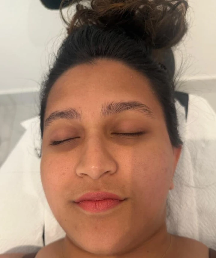 Before HydraFacial, showing congestion typical of humid coastal living near Panadura