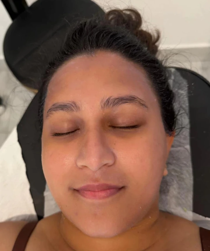 After HydraFacial, brighter hydrated complexion; individual results vary for Panadura patients